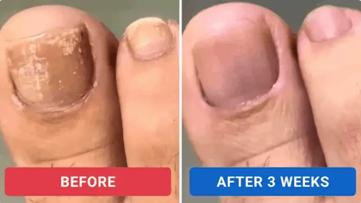 Oroville Nail Fungus Pen customer review Elena