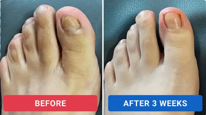 Oroville Nail Fungus Pen customer review Angela F.